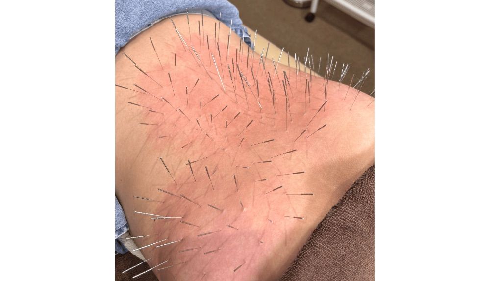 はり処もり　(ルート鍼専門院)