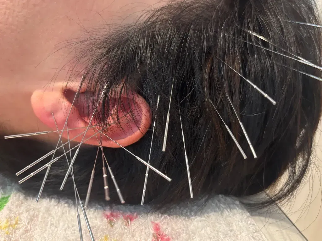 ルート治療HARIーUP