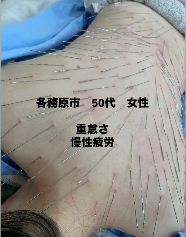 鍼灸院ハレ 岐阜ルート治療