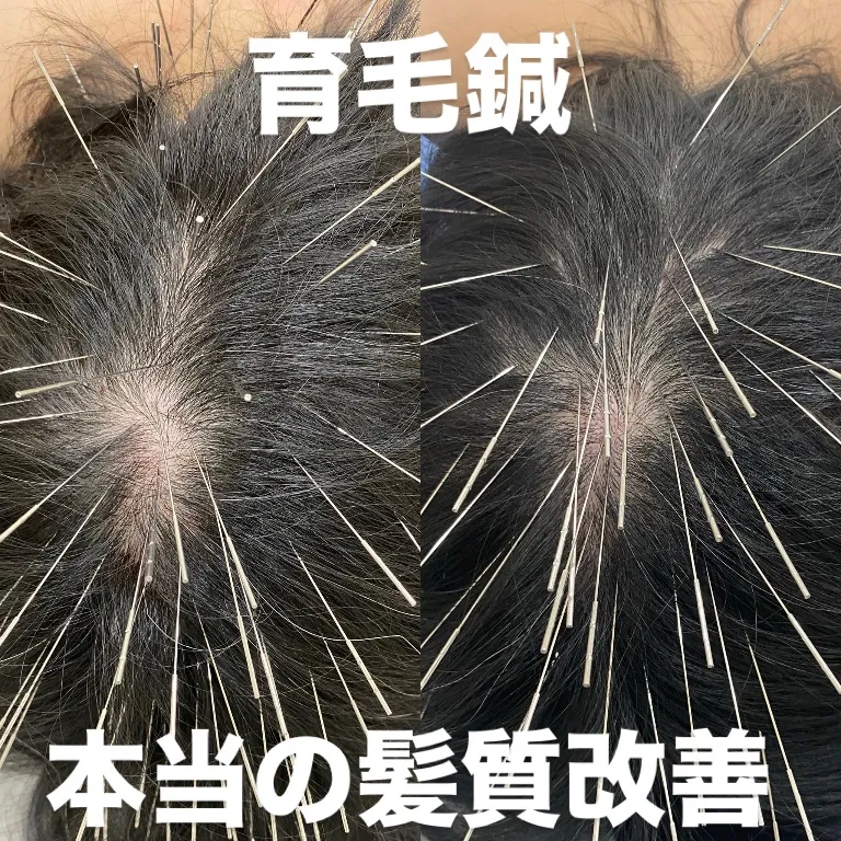鍼灸院ハレ 岐阜ルート治療