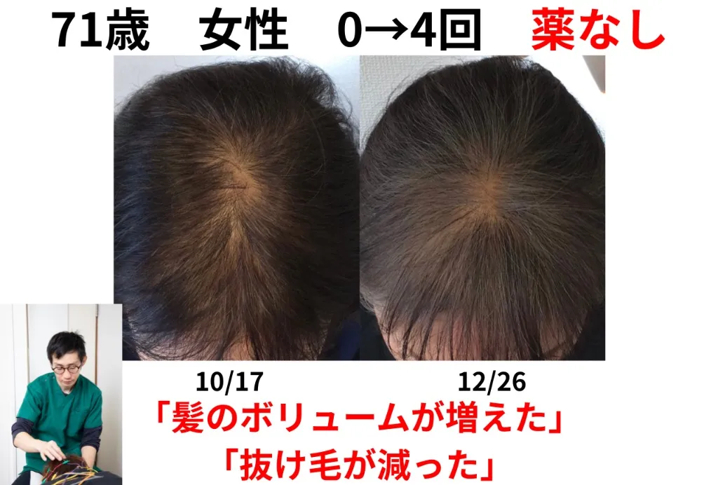 中野区野方鍼灸院のむち鍼