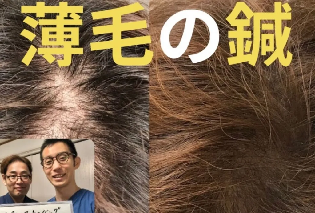 中野区野方鍼灸院のむち鍼