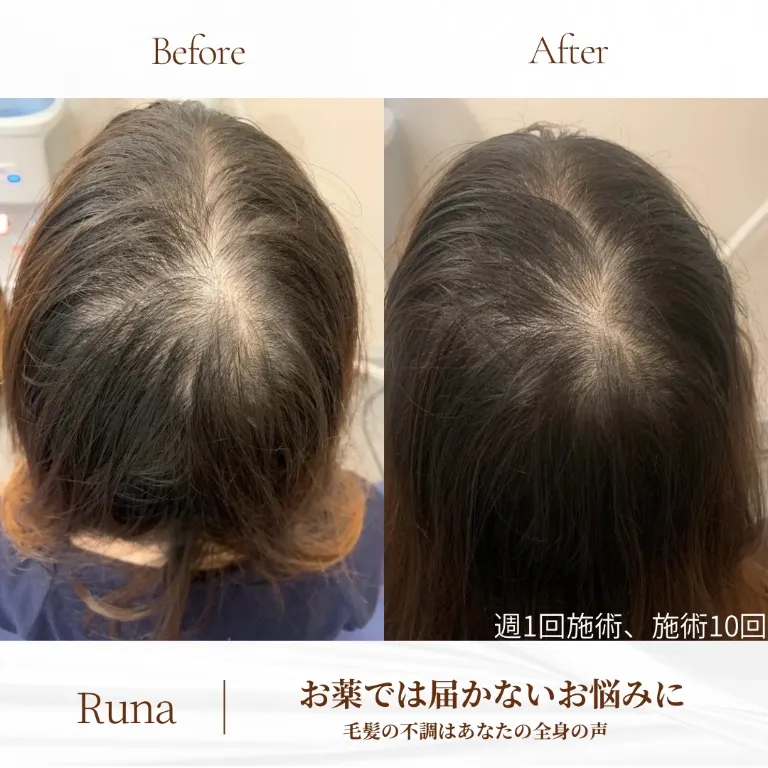 Runa(大阪梅田ルート治療と癒着はがし)