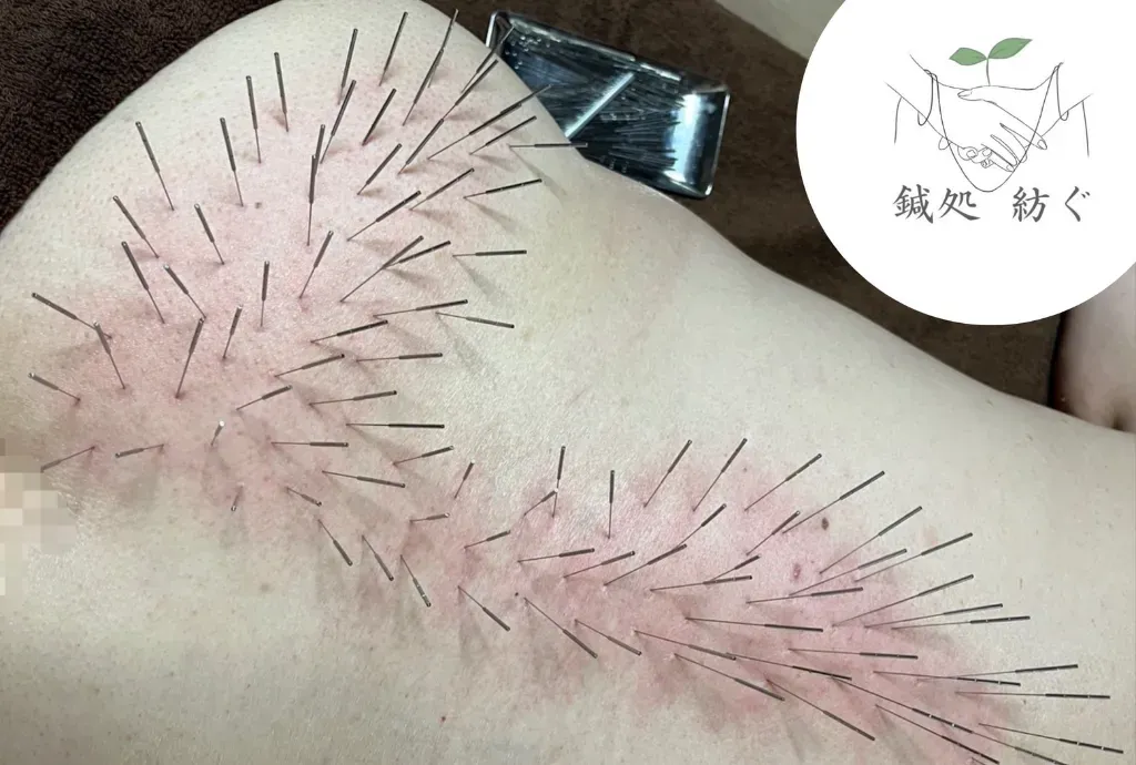 鍼処 紡ぐ