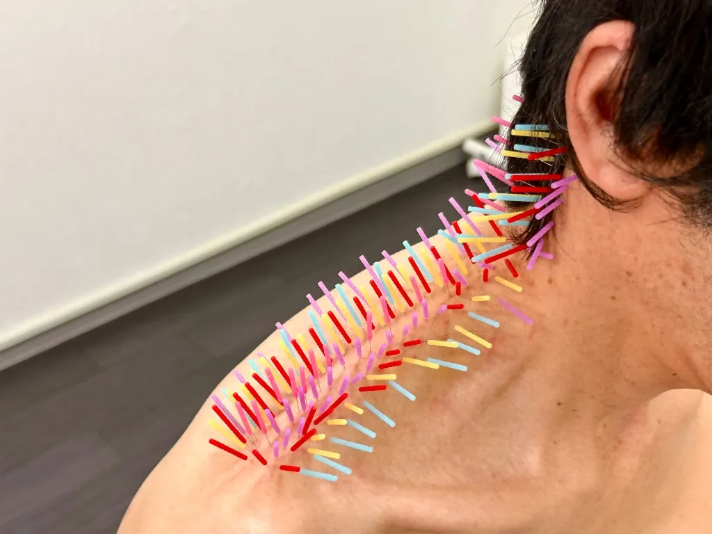 肩こり・腰痛・とだ鍼灸院（トリガーポイント鍼専門）