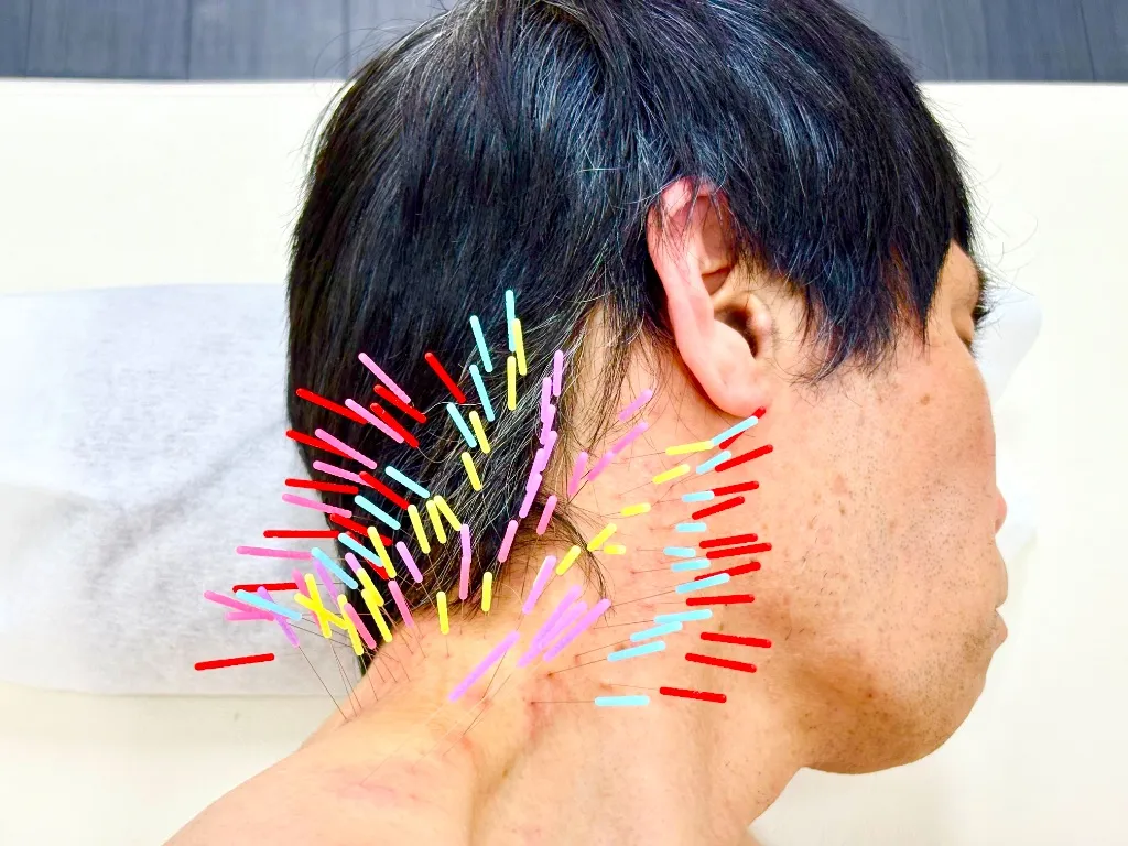 肩こり・腰痛・とだ鍼灸院（トリガーポイント鍼専門）