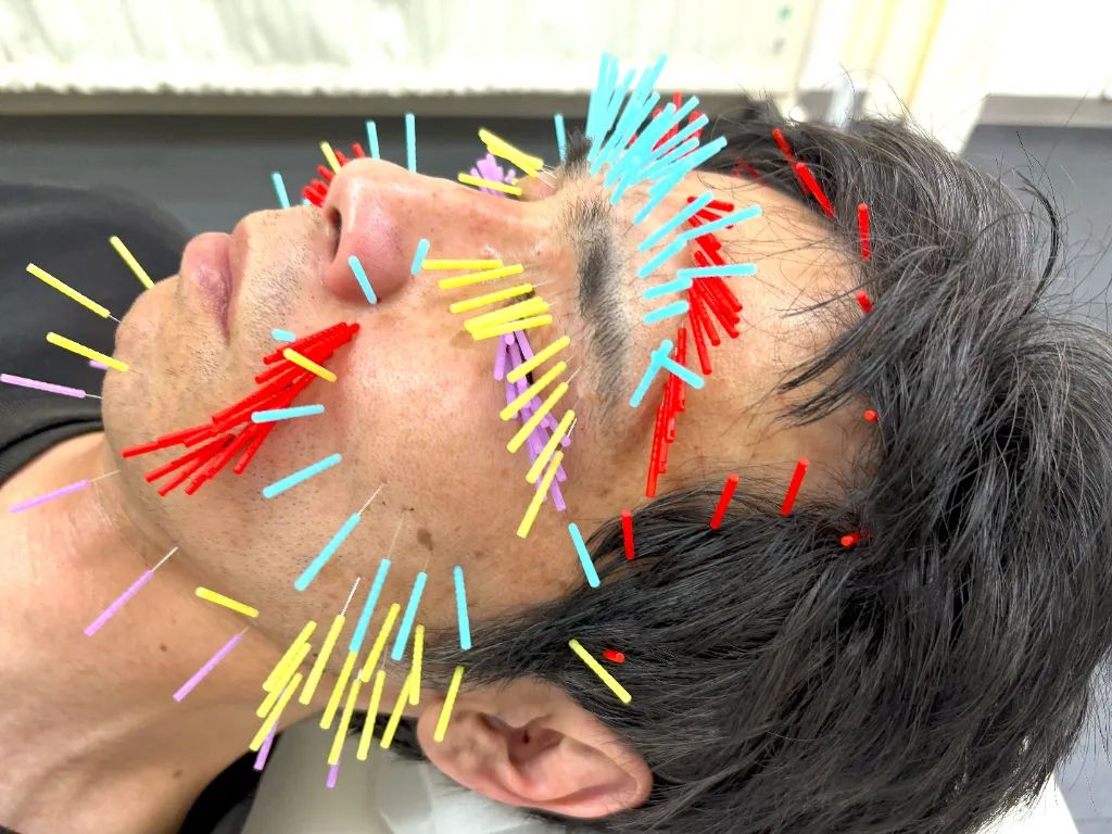肩こり・腰痛・とだ鍼灸院(トリガーポイント鍼専門)