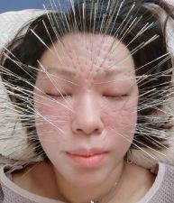 【ルート治療認定院】鍼処さらさ