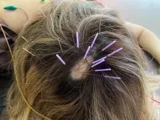 AGA・FAGA・薄毛育毛鍼　　頭皮髪再生治療専門　ハリのち晴れ 鍼灸治療院　浦和院