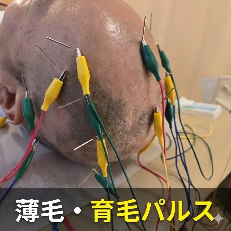 【薄毛・育毛パルス】　悠鍼灸院・整骨院　南浦和