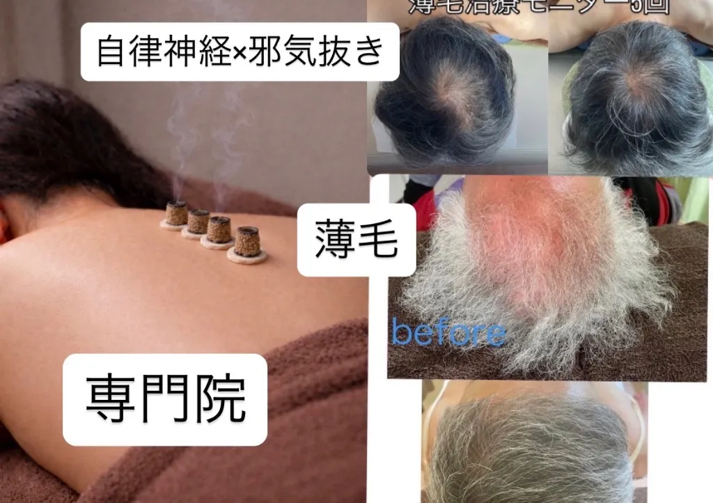 鍼処NAKAGAWA  邪気抜き✖️自律神経薄毛専門