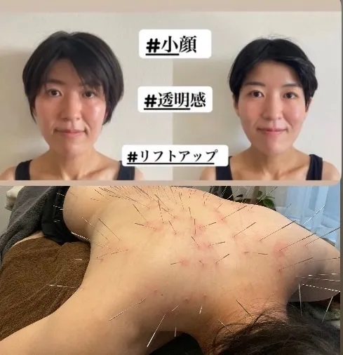 鍼処NAKAGAWA  慢性痛・不調×薄毛専門　周年記念料金実施中