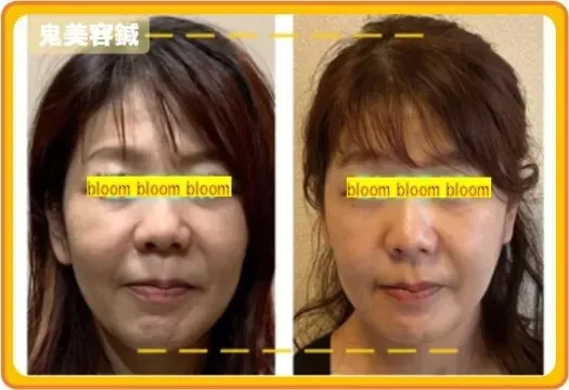 山本鍼灸院-bloom-【ルート治療】【磁線エネルギー施術】