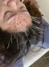 鍼処 藤【ルート治療専門院】