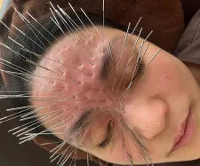 彩り はりきゅう ルート治療認定院