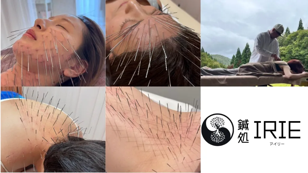 鍼処 IRIE （アイリー）　〜ルート治療専門〜