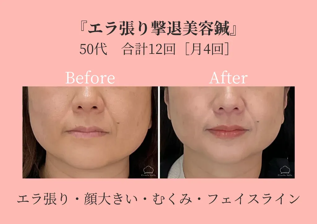 −美容鍼・小顔専門−鍼灸CiruelaValle