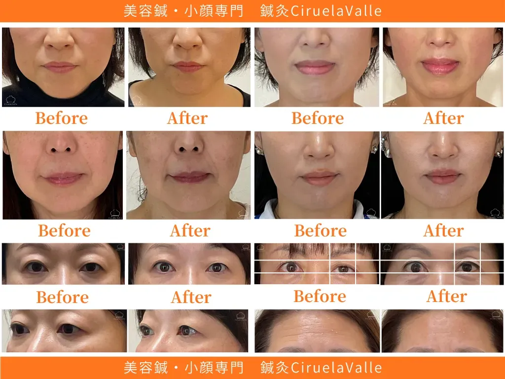 −美容鍼・小顔専門−鍼灸CiruelaValle