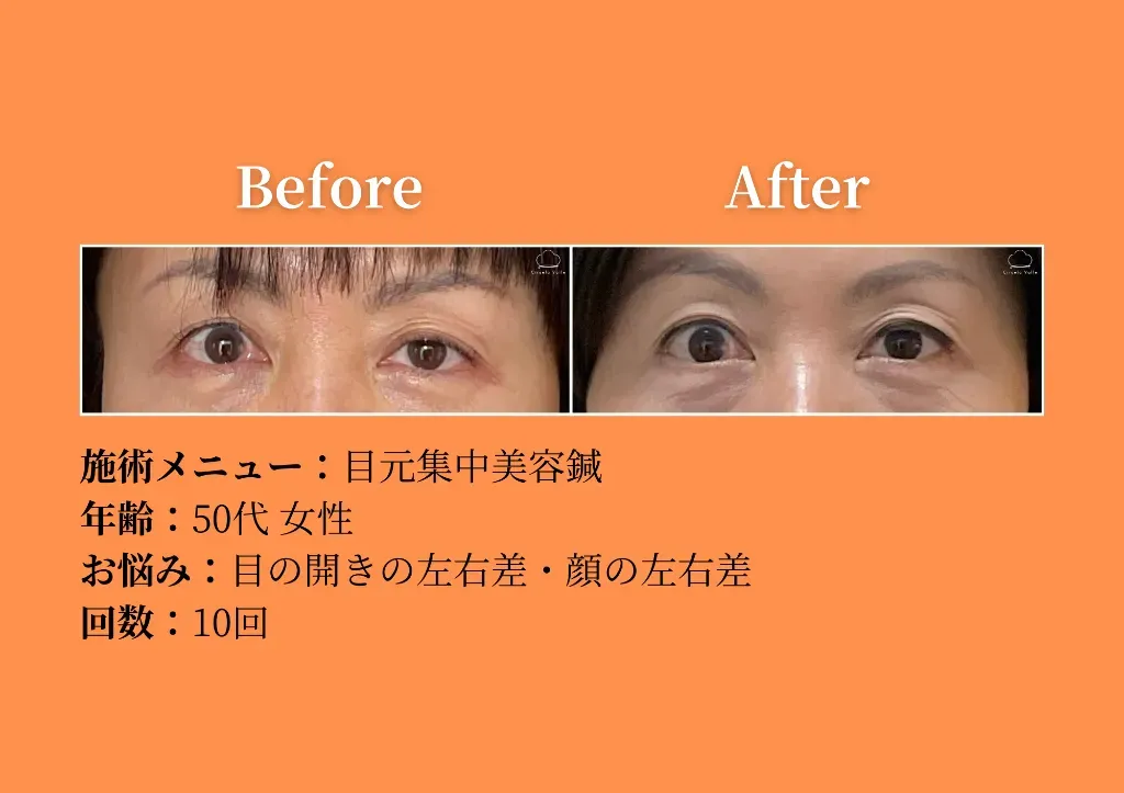 −美容鍼・小顔専門−鍼灸CiruelaValle