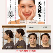 鍼灸院acupital-アキュピタル-