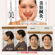 鍼灸院acupital-アキュピタル-