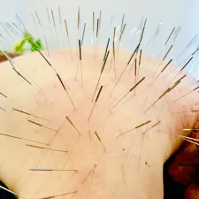 鍼日和