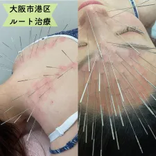 みやけ鍼灸院(ルート治療)