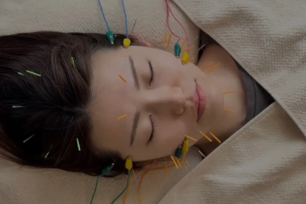 美容鍼こはりび