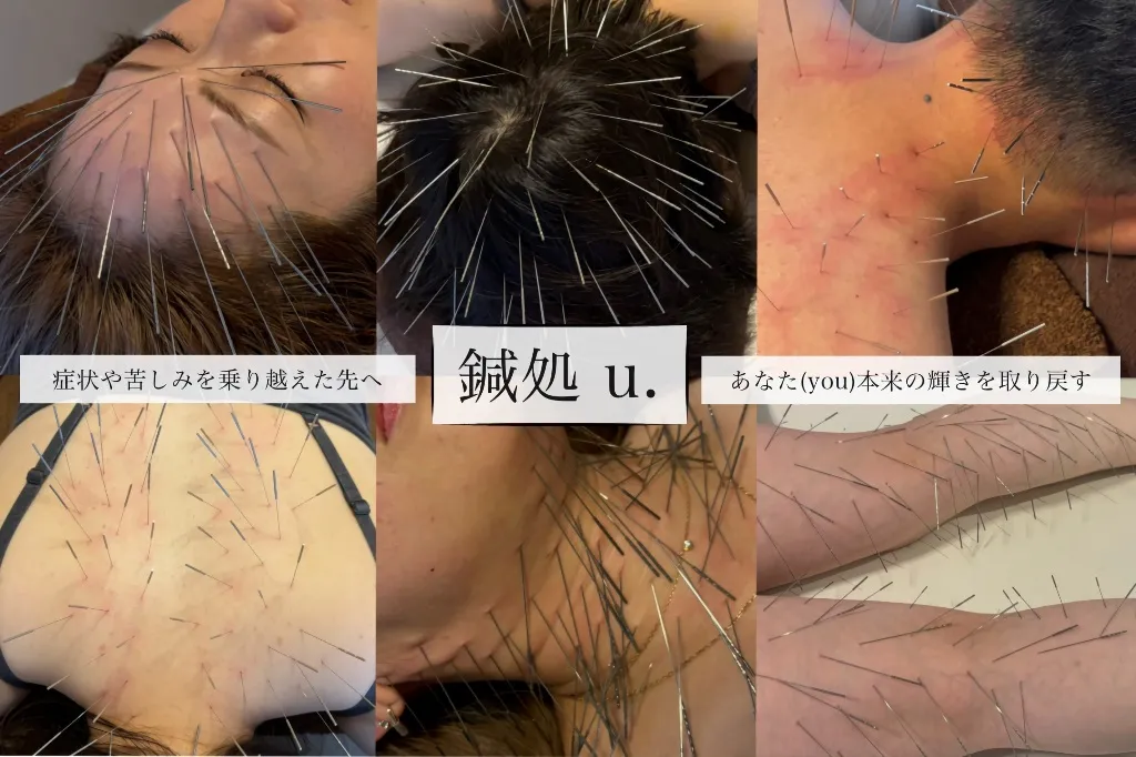 鍼処 u.【ルート治療専門】