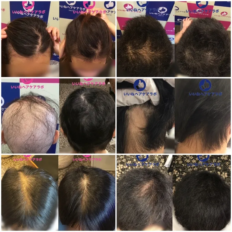 薬なし薄毛専門鍼灸院｜いいねヘアケアラボ 名古屋院