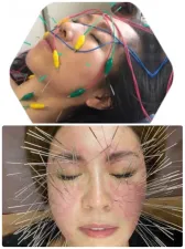 美容鍼とルート治療による鬼美容鍼 まちばり鍼灸院