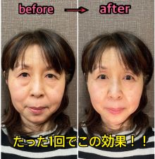 福山小顔美容鍼サロン