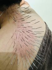 プロアスリート鍼灸整骨院