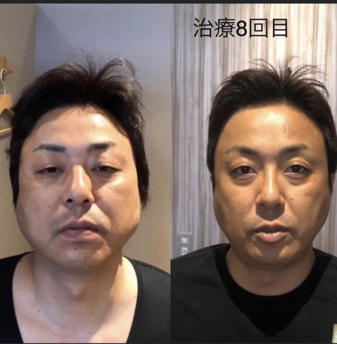 広島美容鍼【月陽堂鍼灸治療院】ルート治療のこだわりポイント