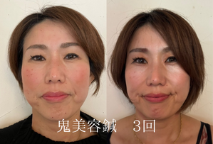 アイリー鍼灸院　〜ルート治療専門〜のこだわりポイント