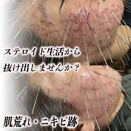 鍼処 紡ぐのこだわりポイント