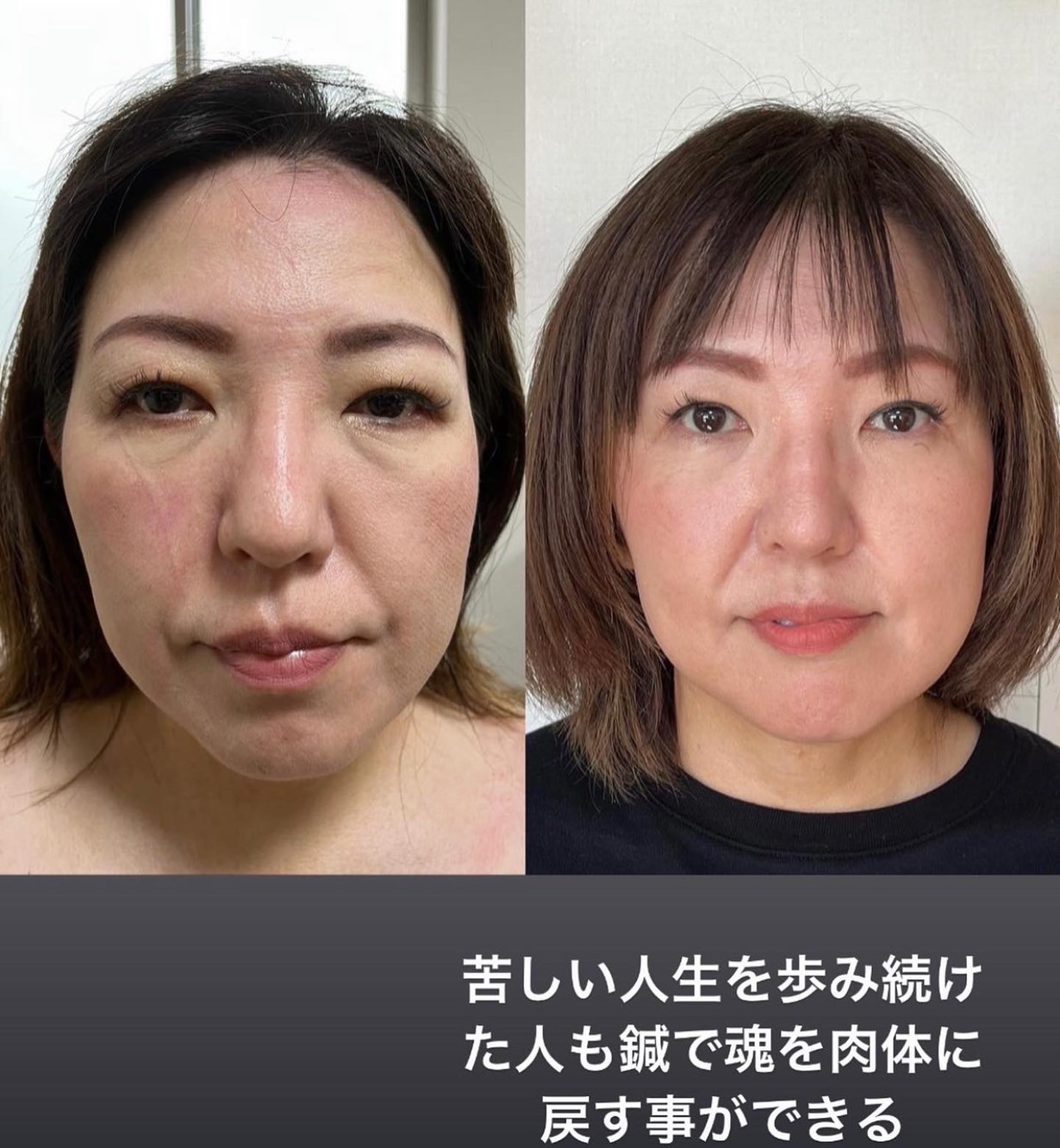広島美容鍼【月陽堂鍼灸治療院】ルート治療 鬼美容鍼 半枠 (顔面のみの施術）のメニュー画像