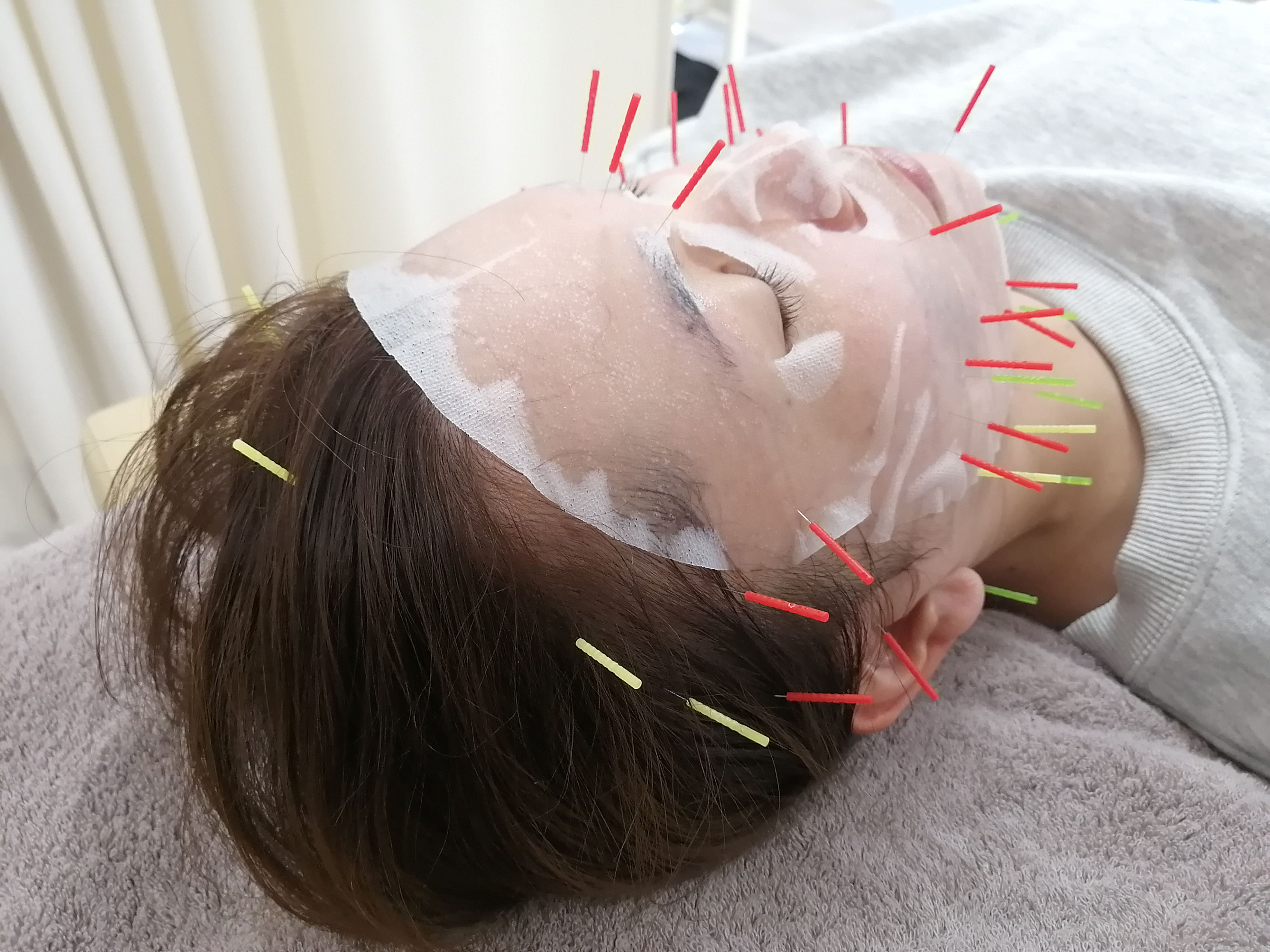 Acure鍼灸整体サロン **ご新規様限定**＜九州でも希少な＞ヒト幹細胞美容鍼のメニュー画像