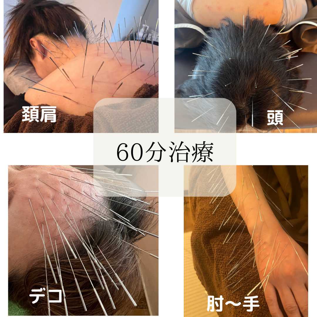 けんたろう鍼灸院 ルート鍼治療　60分のメニュー画像