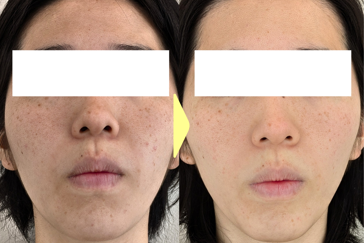 【美容鍼・育毛鍼】はりきゅうeFu-エフ- 【新規】毛穴・くすみケア美容鍼【ヒト幹細胞美容鍼】2回目以降16,000円のメニュー画像