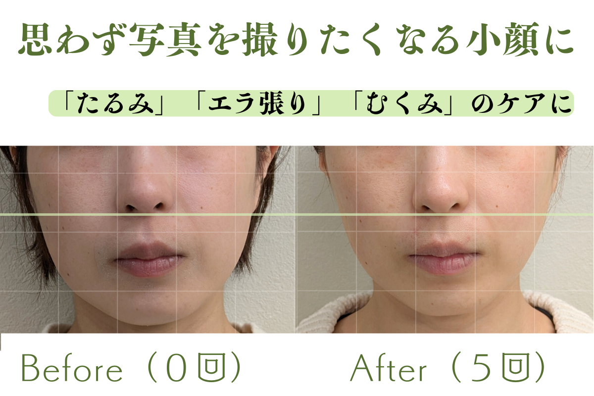 【美容鍼・育毛鍼】はりきゅうeFu-エフ- 【平日のみ|毎月3名限定：9月1名】『美容鍼』トライアルコース /通常13,000円のメニュー画像