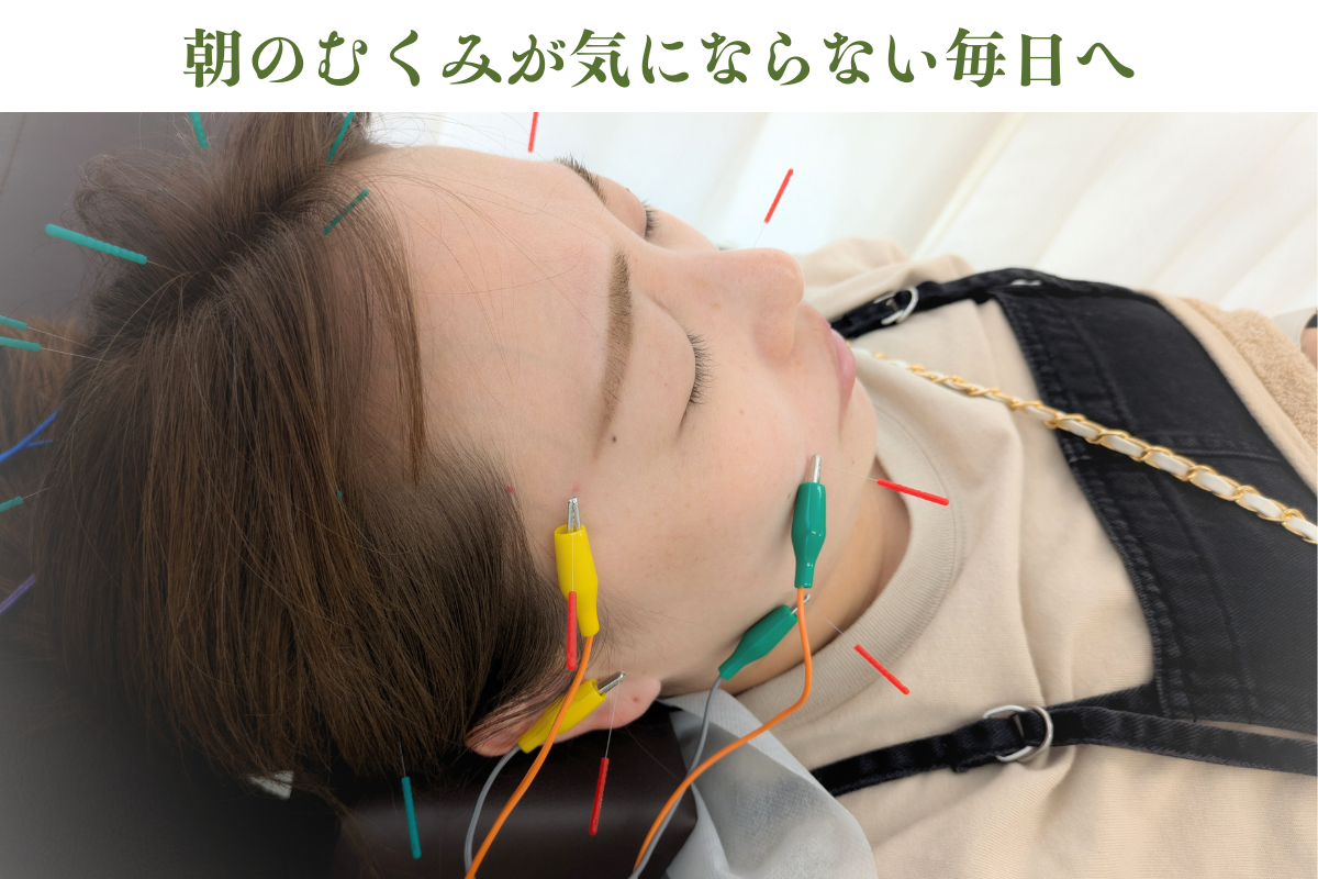 【美容鍼・育毛鍼】はりきゅうeFu-エフ- 【2回目以降】小顔・フェイスラインスッキリ美容鍼のメニュー画像