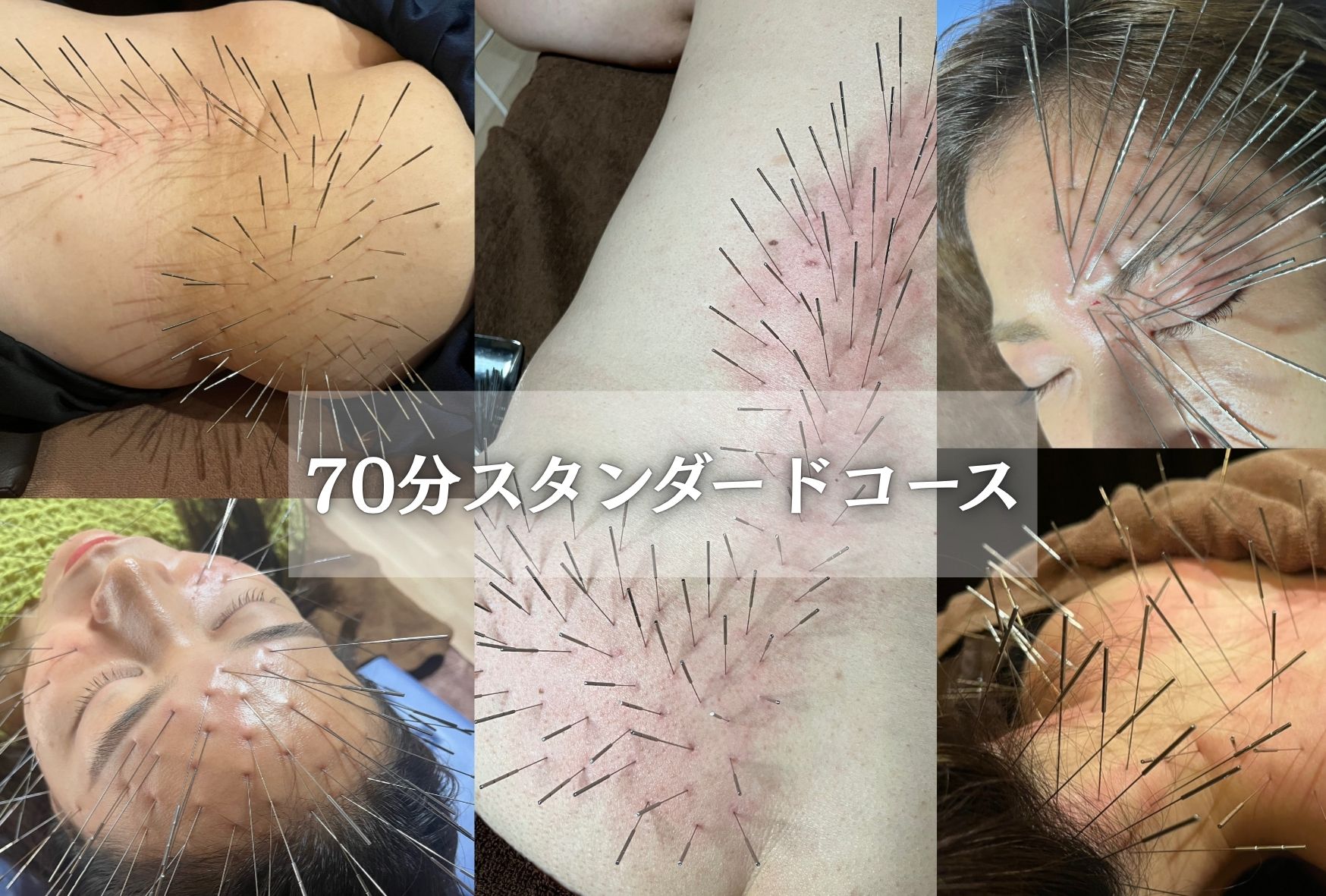 鍼処 紡ぐのメニュー選択 | 北九州市周辺の鍼灸院・美容鍼サロン