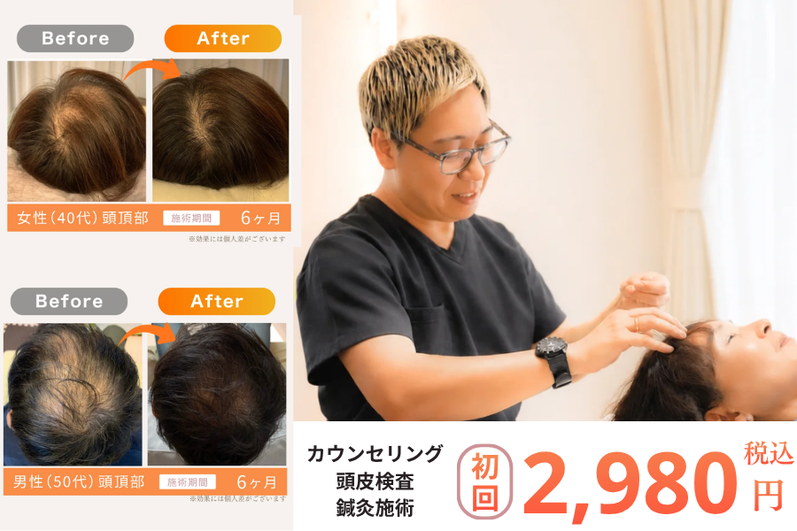 【育毛鍼】鍼灸院Roots　宝塚院 【人気No.1】初回限定　育毛鍼　頭皮鍼　（抜け毛/薄毛）のメニュー画像