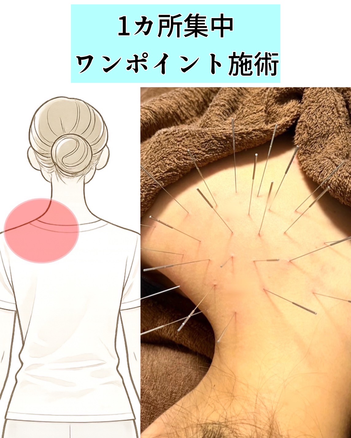 はり灸こころね １部位集中・ワンポイント施術のメニュー画像