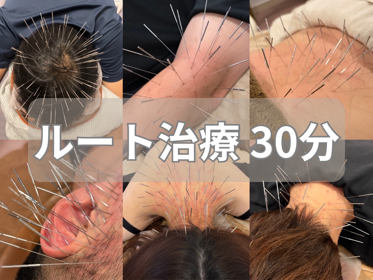 tubomi -美、癒し処- 【総鍼数50本以上！部分的な不調・痛み】ルート鍼30分　10000円→6000円のメニュー画像