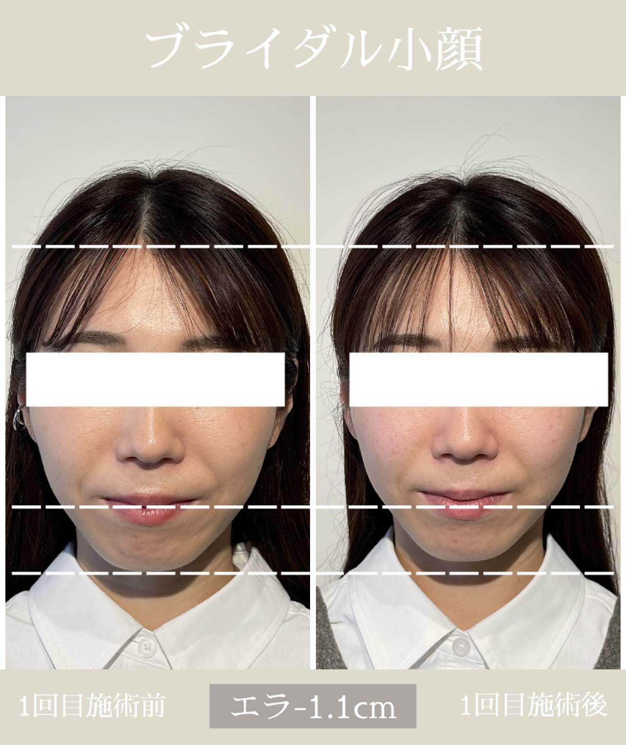 小顔矯正・美容鍼灸salon Yusaku 院詳細 | 本町・船場の鍼灸院・美容鍼